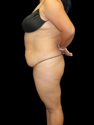 Tummy Tuck Tummy Tuck 5 - Before