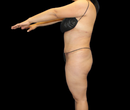 Tummy Tuck: Case 11 - After