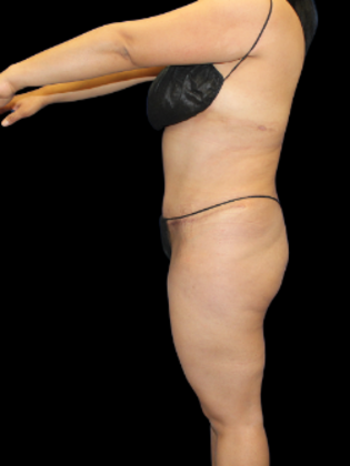 Tummy Tuck Tummy Tuck 5 - After