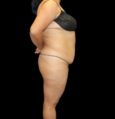 Tummy Tuck: Case 11 - Before