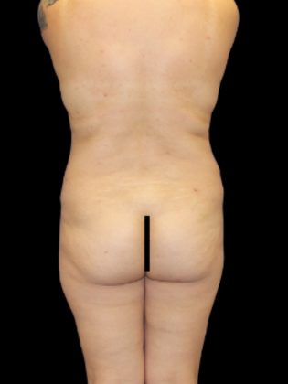 Brazilian Butt Lift Case 30 - Before