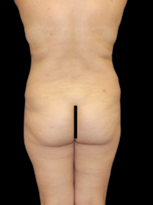 Brazilian Butt Lift BBL 8 - Before