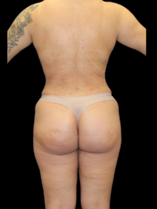 Brazilian Butt Lift Case 30 - After