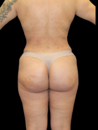 Brazilian Butt Lift BBL 8 - After