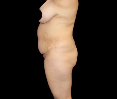 Brazilian Butt Lift: Case 30 - Before