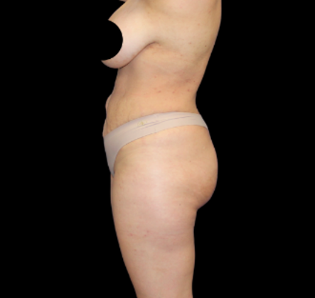 Brazilian Butt Lift: Case 30 - After