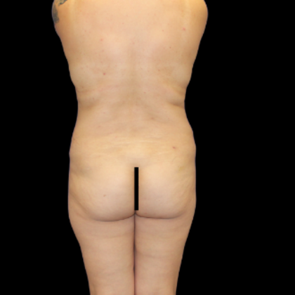 Liposuction Case 19 - Before