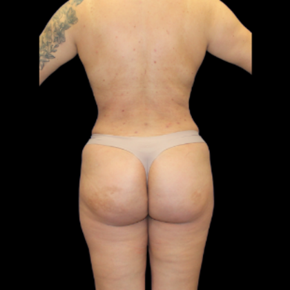 Liposuction Case 19 - After