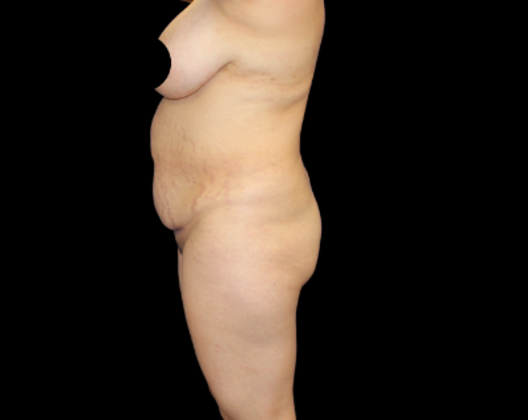 Liposuction: Case 19 - Before