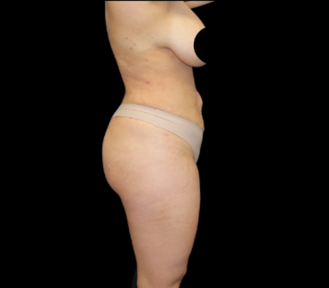Liposuction: Case 19 - After