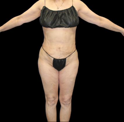Liposuction: Case 20 - After
