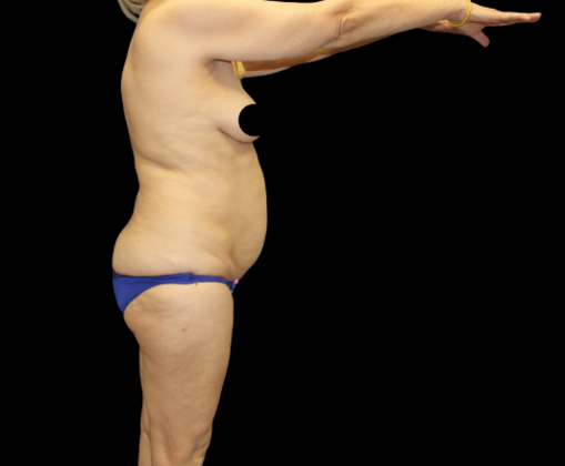 Liposuction: Case 20 - Before