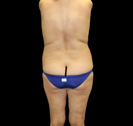 Liposuction: Case 20 - Before