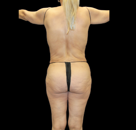 Liposuction: Case 20 - After