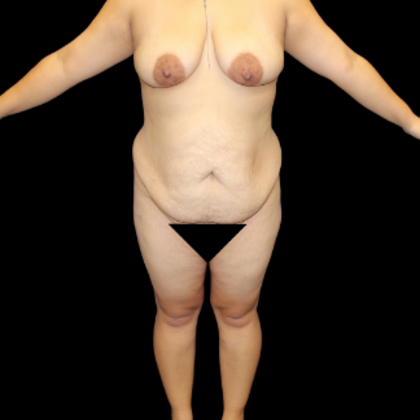 Tummy Tuck Case 12 - Before