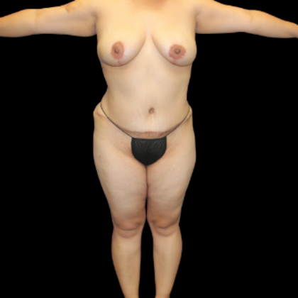 Tummy Tuck Case 12 - After