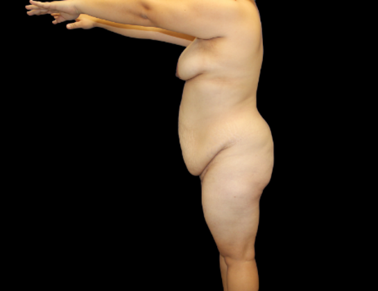 Tummy Tuck: Case 12 - Before