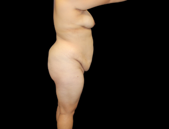 Tummy Tuck: Case 12 - Before