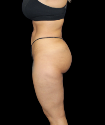 Brazilian Butt Lift Case 31 - After