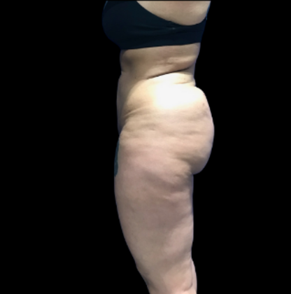 Brazilian Butt Lift Case 31 - Before