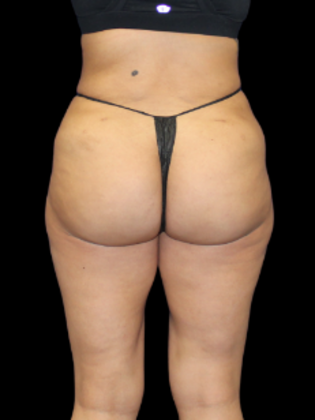 Brazilian Butt Lift: Case 31 - After