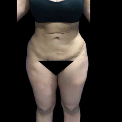 Brazilian Butt Lift: Case 31 - Before