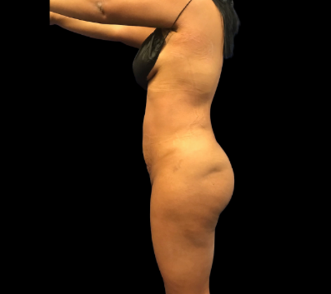 Brazilian Butt Lift: Case 32 - After