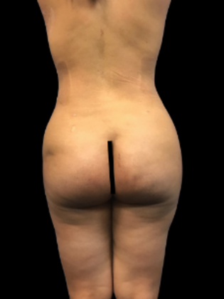 Brazilian Butt Lift BBL 23 - After