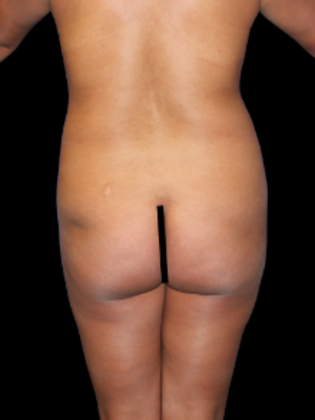 Brazilian Butt Lift BBL 23 - Before