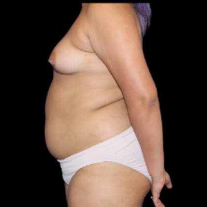 Breast Augmentation: Case 6 - Before