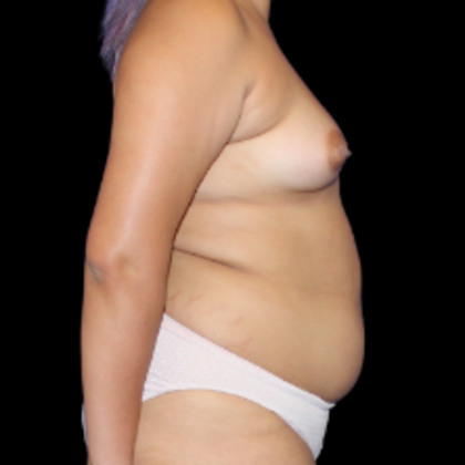 Breast Augmentation: Case 6 - Before