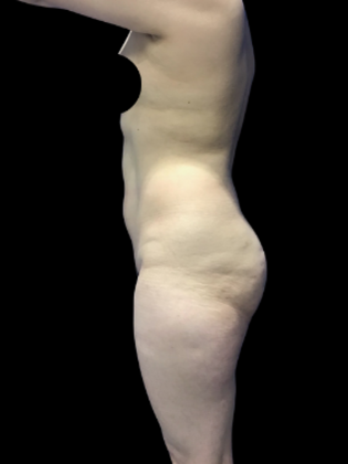 Brazilian Butt Lift Case 33 - Before