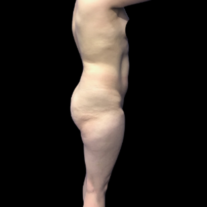 Brazilian Butt Lift: Case 33 - Before