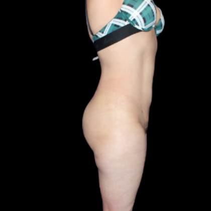 Brazilian Butt Lift: Case 33 - After