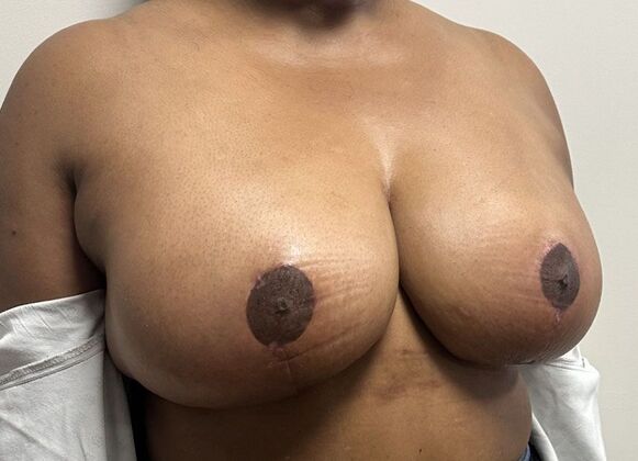 Breast Reduction: Case 4 - After