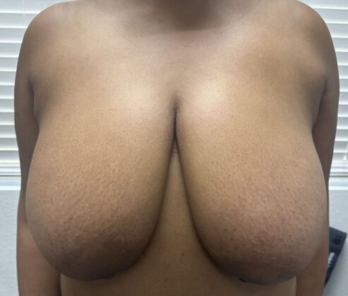 Breast Reduction: Case 4 - Before