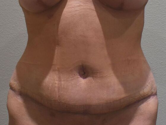 Tummy Tuck (Abdominoplasty): Case 578 - After