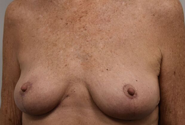Breast Lift (Mastopexy): Case 261 - After