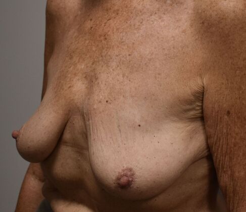Breast Lift (Mastopexy): Case 261 - Before