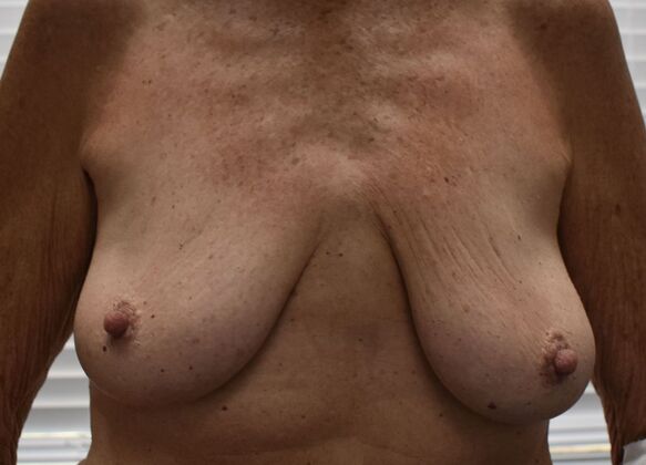 Breast Lift (Mastopexy) Case 261 - Before