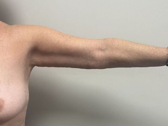Brachioplasty: Case 27 - After