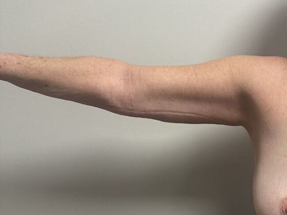 Brachioplasty Case 27 - After