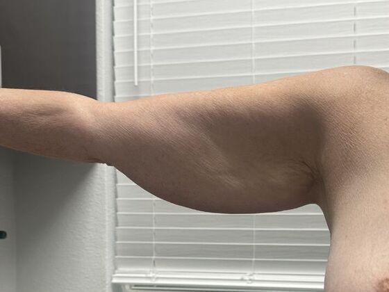 Brachioplasty Case 27 - Before