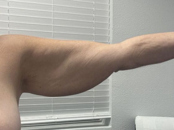Brachioplasty: Case 27 - Before