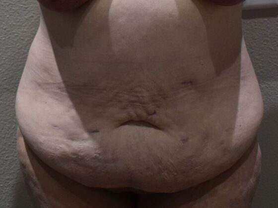 Tummy Tuck (Abdominoplasty): Case 579 - Before