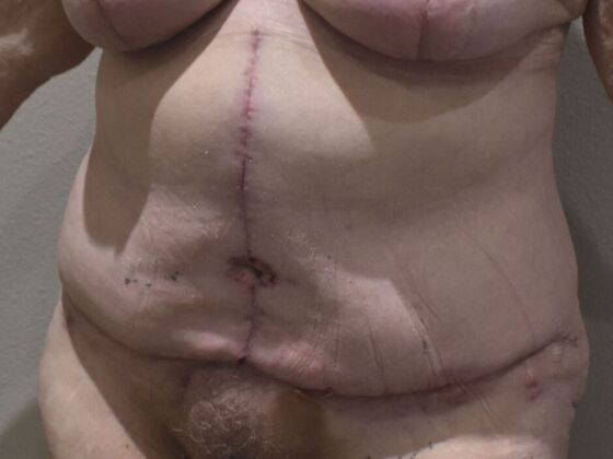 Tummy Tuck (Abdominoplasty): Case 579 - After