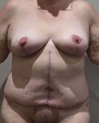 Massive Weight Loss : Case 206 - After