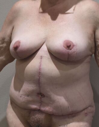 Massive Weight Loss : Case 206 - After