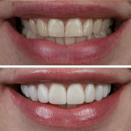 SmileSculpt Veneers Tracy - Before