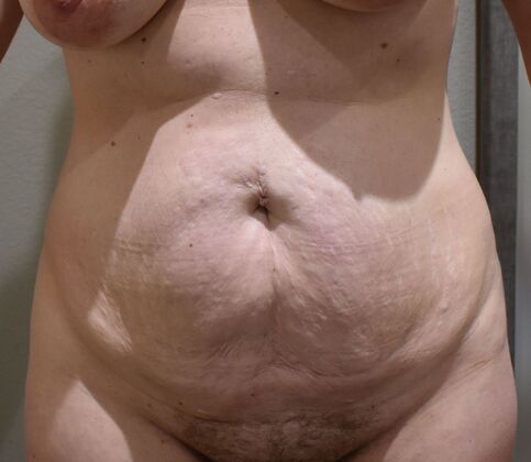 Tummy Tuck (Abdominoplasty): Case 580 - Before